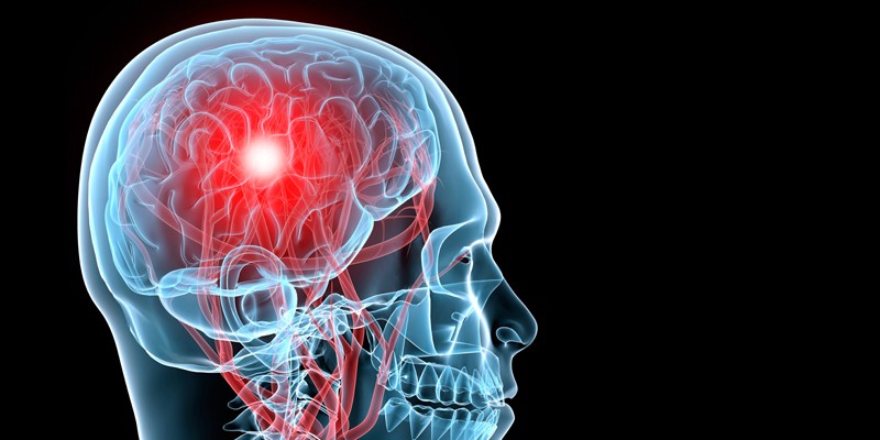 Brain Injury